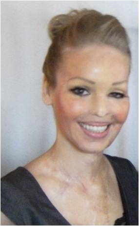 Katie Piper In 2008 Katie had sulphuric acid thrown on her face after being